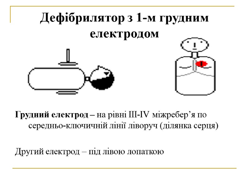 Дефібрилятор з 1-м грудним електродом Грудний електрод – на рівні III-IV міжребер’я по середньо-ключичній